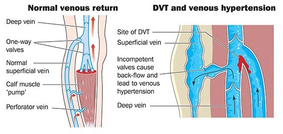 Most Common Veins For Dvt _ Deep Venous Thrombosis (DVT) – ZVTQZ